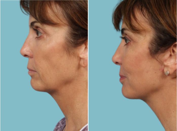 Before & After Fat Grafting by Dr. Mustoe Case 924 Left Side View in Chicago, IL