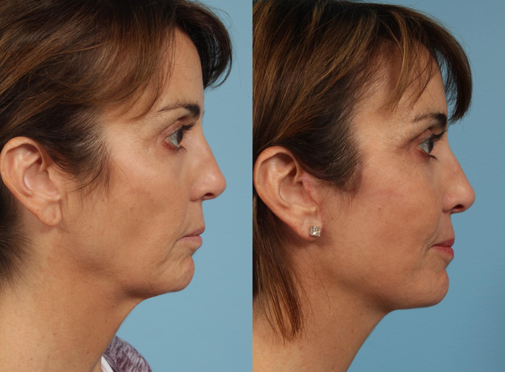 Before & After Deep Plane Facelift by Dr. Mustoe Case 924 Right Side View in Chicago, IL