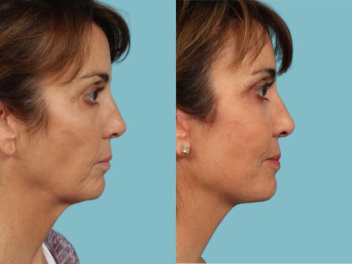Before & After Facelift/Minilift by Dr. Mustoe Case 924 Right Side View in Chicago, IL