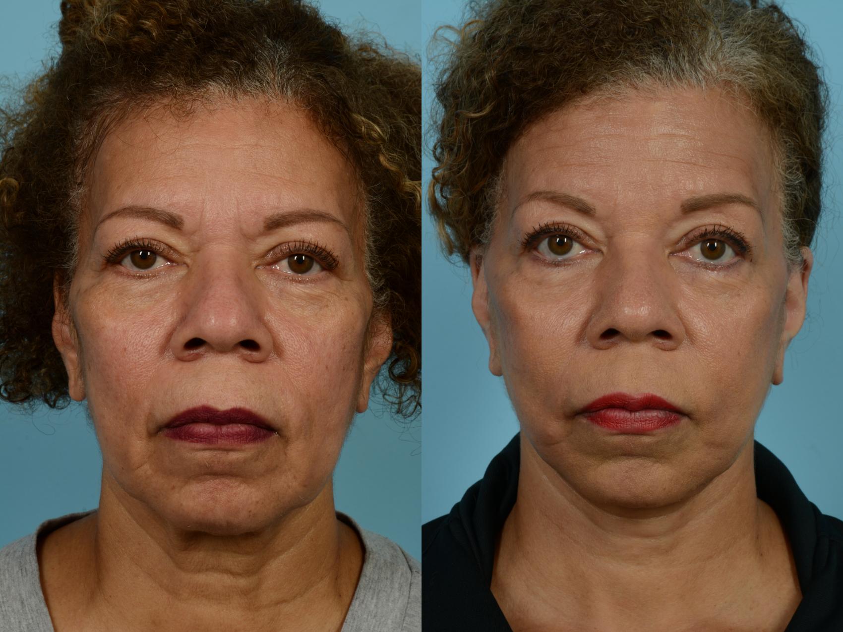 Before & After Neck Lift by Dr. Mustoe Case 926 Front View in Chicago, IL