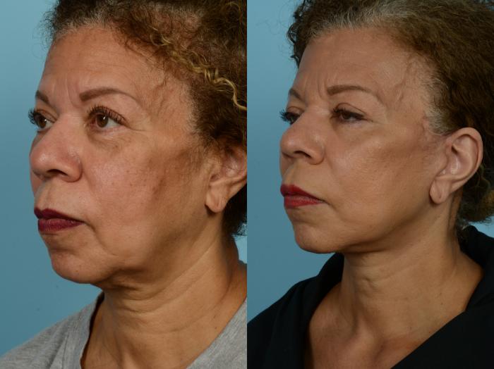 Before & After Neck Lift by Dr. Mustoe Case 926 Left Oblique View in Chicago, IL