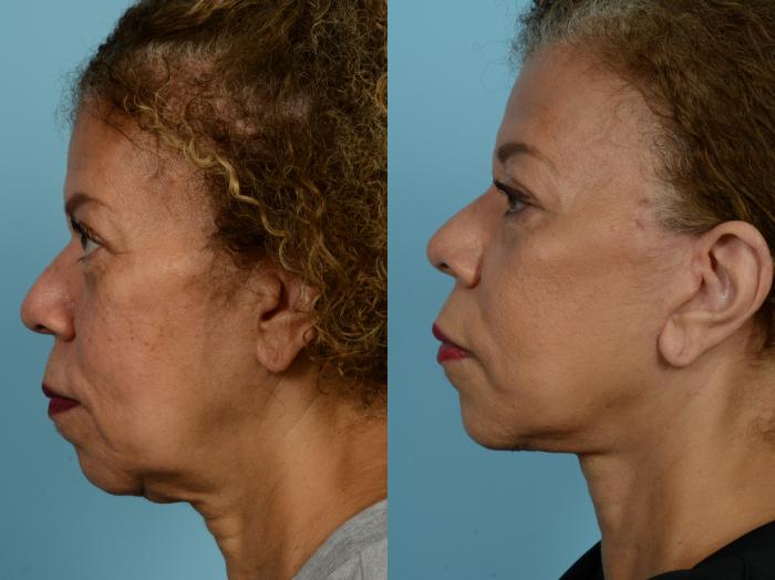 Before & After Neck Lift by Dr. Mustoe Case 926 Left Side View in Chicago, IL