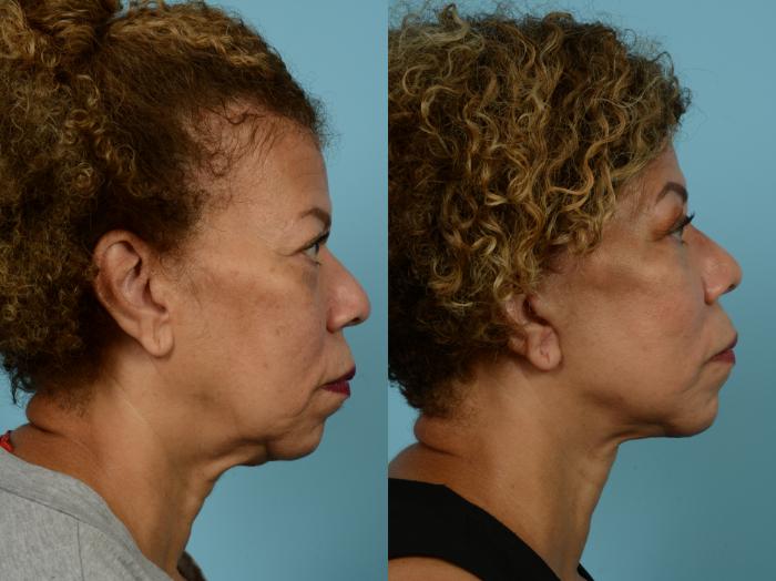 Before & After Neck Lift by Dr. Mustoe Case 926 Right Side View in Chicago, IL