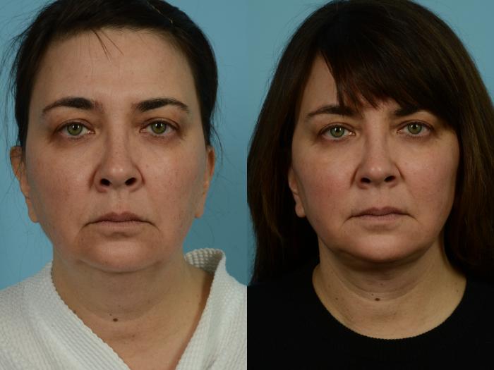 Before & After Facelift/Minilift by Dr. Mustoe Case 928 Front View in Chicago, IL