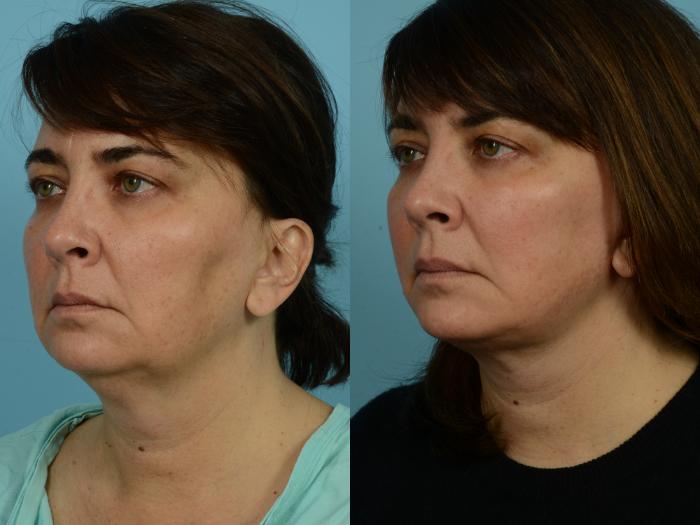 Before & After Facelift/Minilift by Dr. Mustoe Case 928 Left Oblique View in Chicago, IL