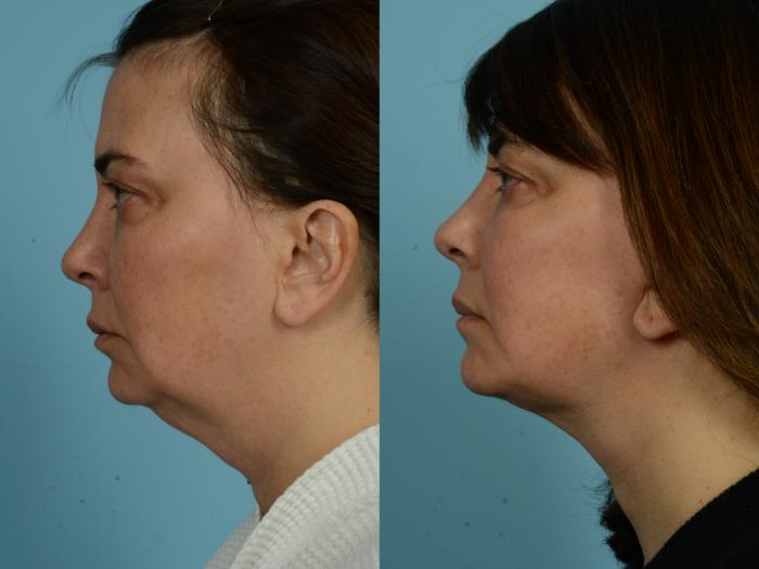 Before & After Facelift/Minilift by Dr. Mustoe Case 928 Left Side View in Chicago, IL