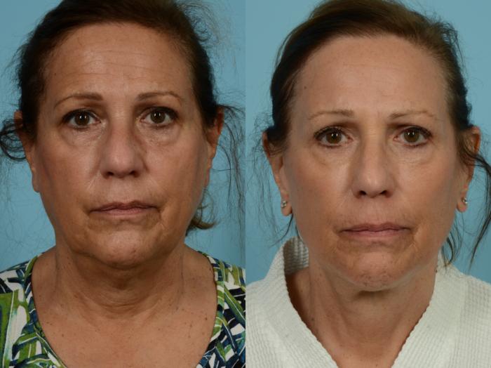 Before & After Neck Lift by Dr. Mustoe Case 929 Front View in Chicago, IL
