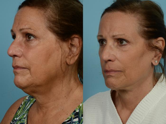 Before & After Neck Lift by Dr. Mustoe Case 929 Left Oblique View in Chicago, IL