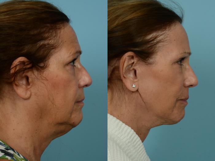 Before & After Neck Lift by Dr. Mustoe Case 929 Right Side View in Chicago, IL