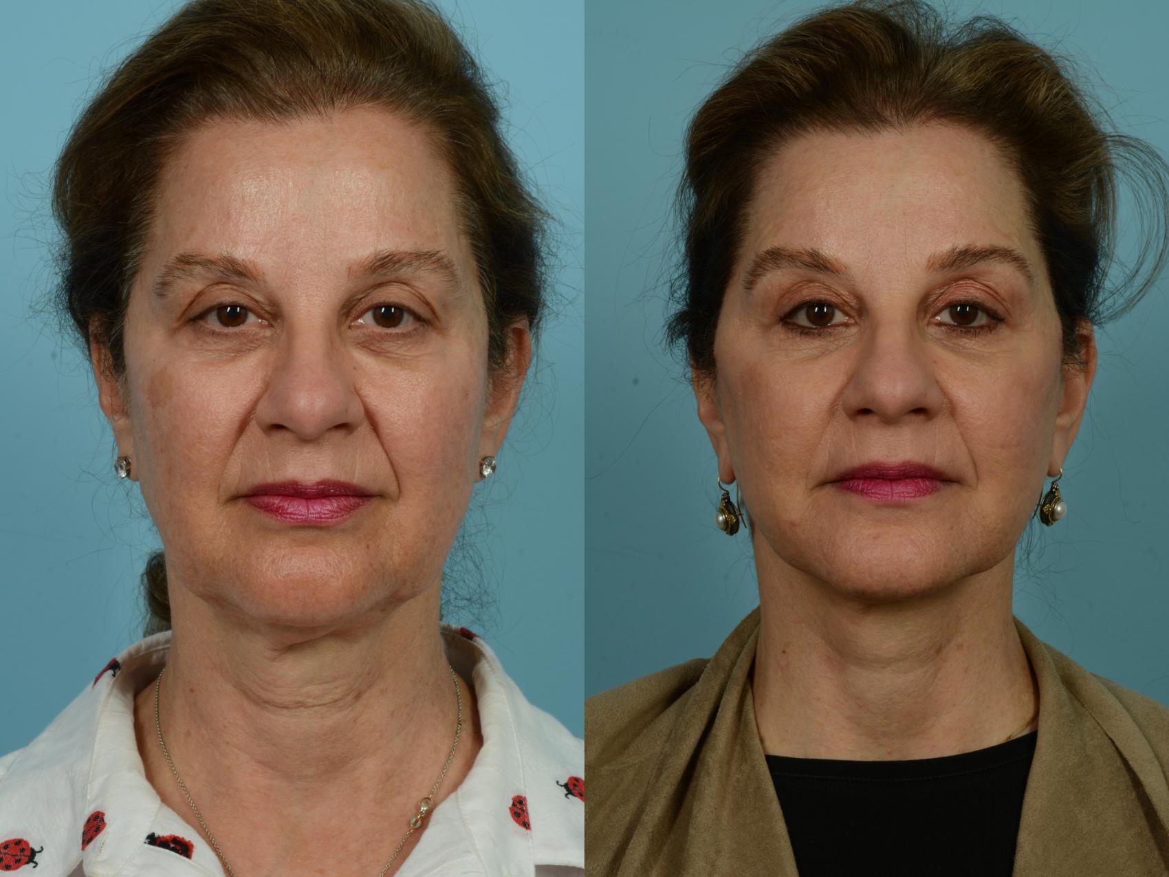 Before & After Facelift/Minilift by Dr. Mustoe Case 930 Front View in Chicago, IL