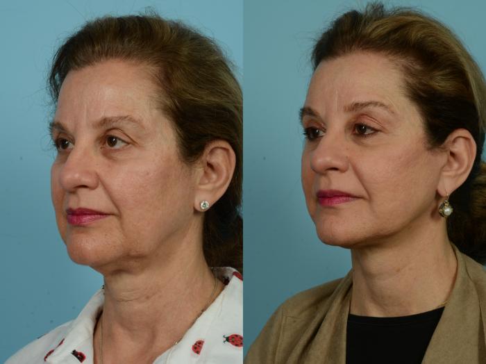 Before & After Facelift/Minilift by Dr. Mustoe Case 930 Left Oblique View in Chicago, IL