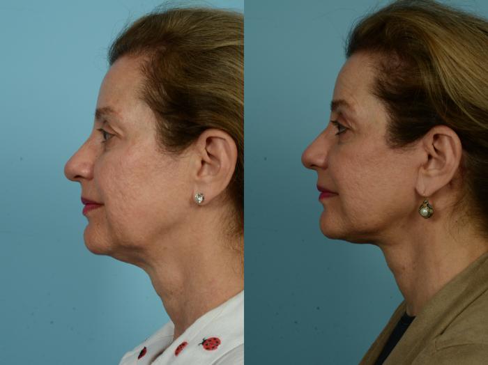 Before & After Facelift/Minilift by Dr. Mustoe Case 930 Left Side View in Chicago, IL