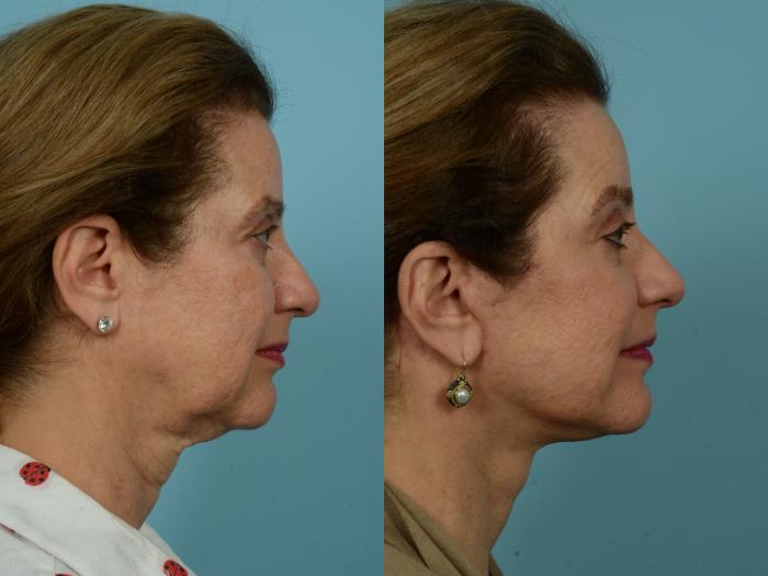 Before & After Facelift/Minilift by Dr. Mustoe Case 930 Right Side View in Chicago, IL