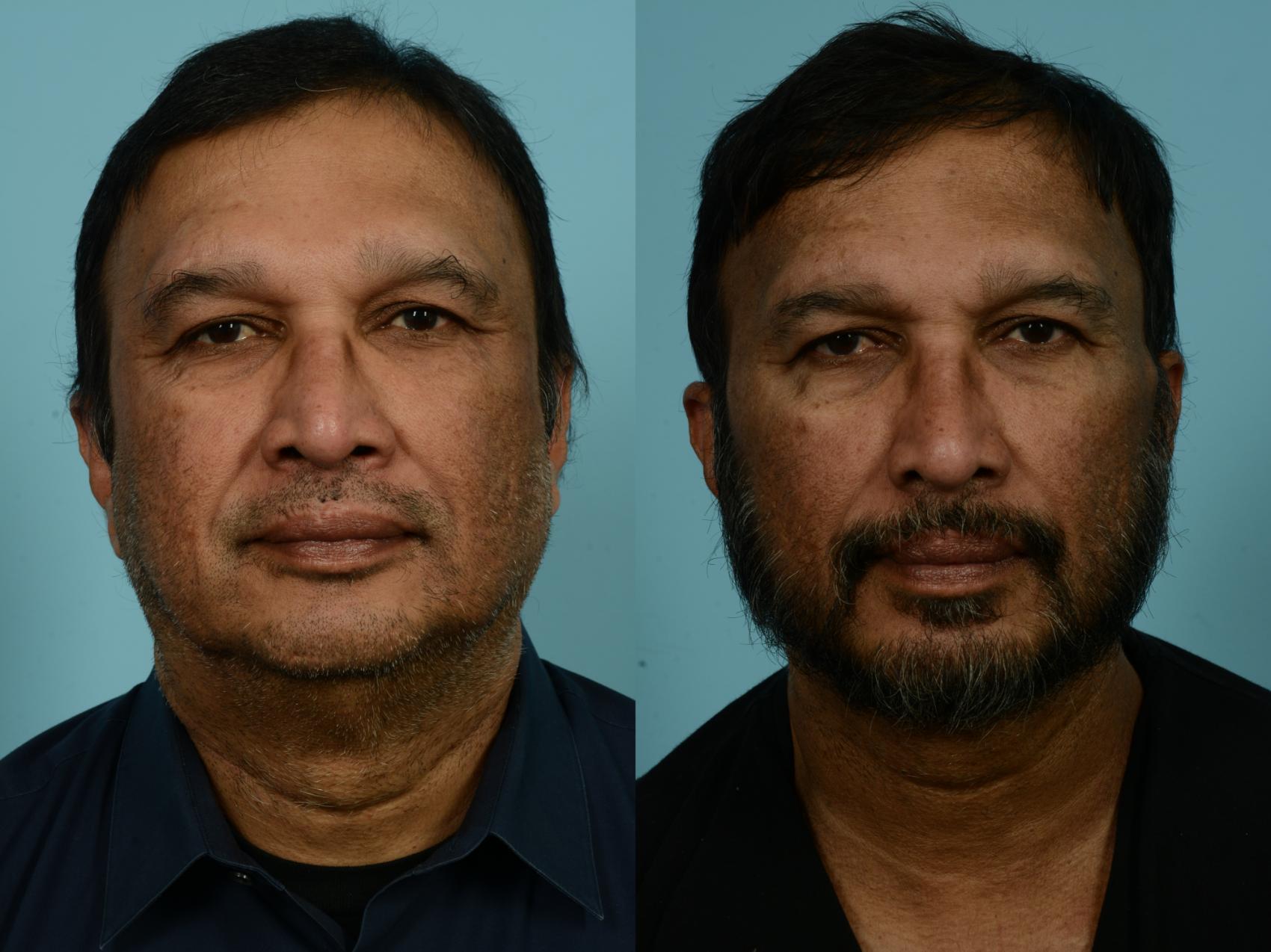 Before & After Neck Lift by Dr. Mustoe Case 931 Front View in Chicago, IL