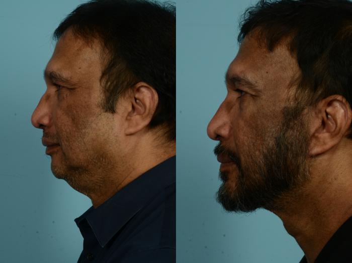 Before & After Neck Lift by Dr. Mustoe Case 931 Left Side View in Chicago, IL