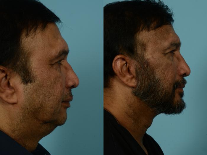 Before & After Neck Lift by Dr. Mustoe Case 931 Right Side View in Chicago, IL