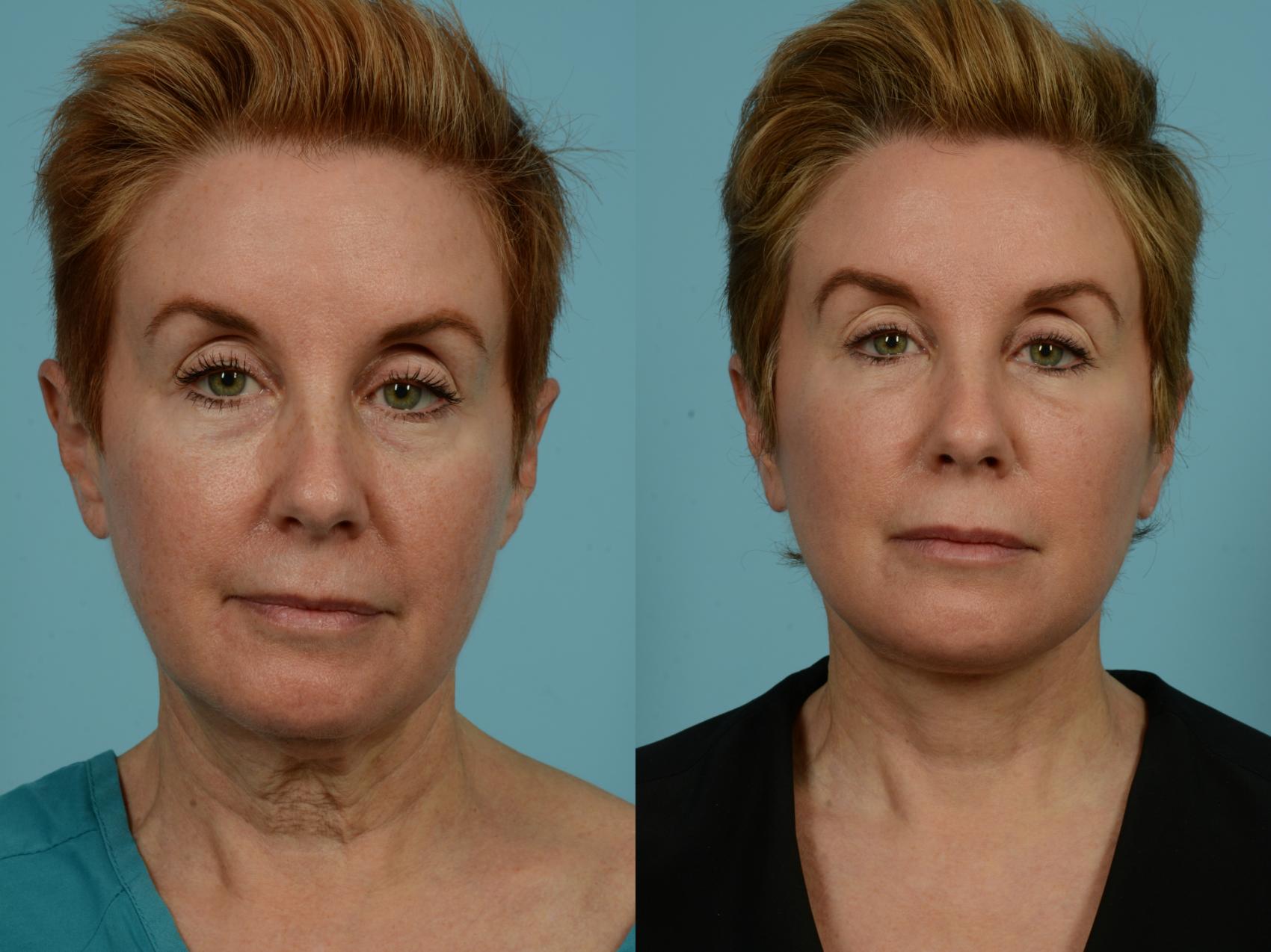 Before & After Facelift/Minilift by Dr. Mustoe Case 932 Front View in Chicago, IL