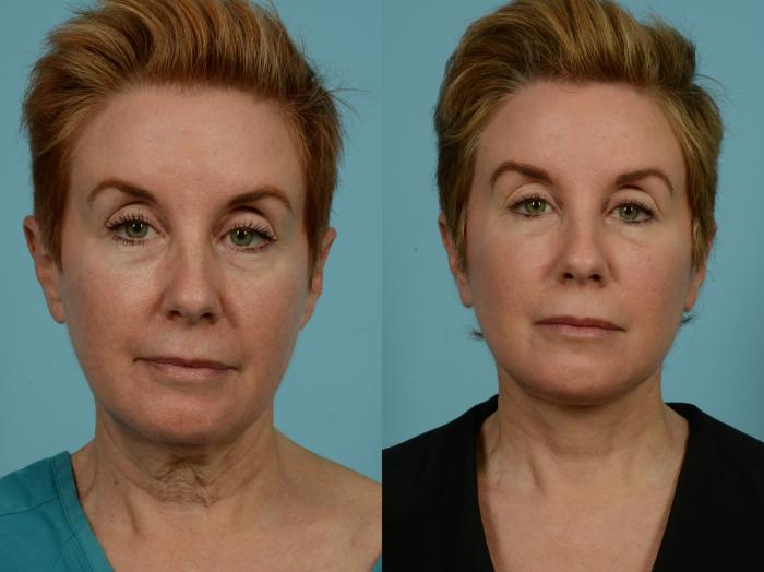 Before & After Neck Lift by Dr. Mustoe Case 932 Front View in Chicago, IL