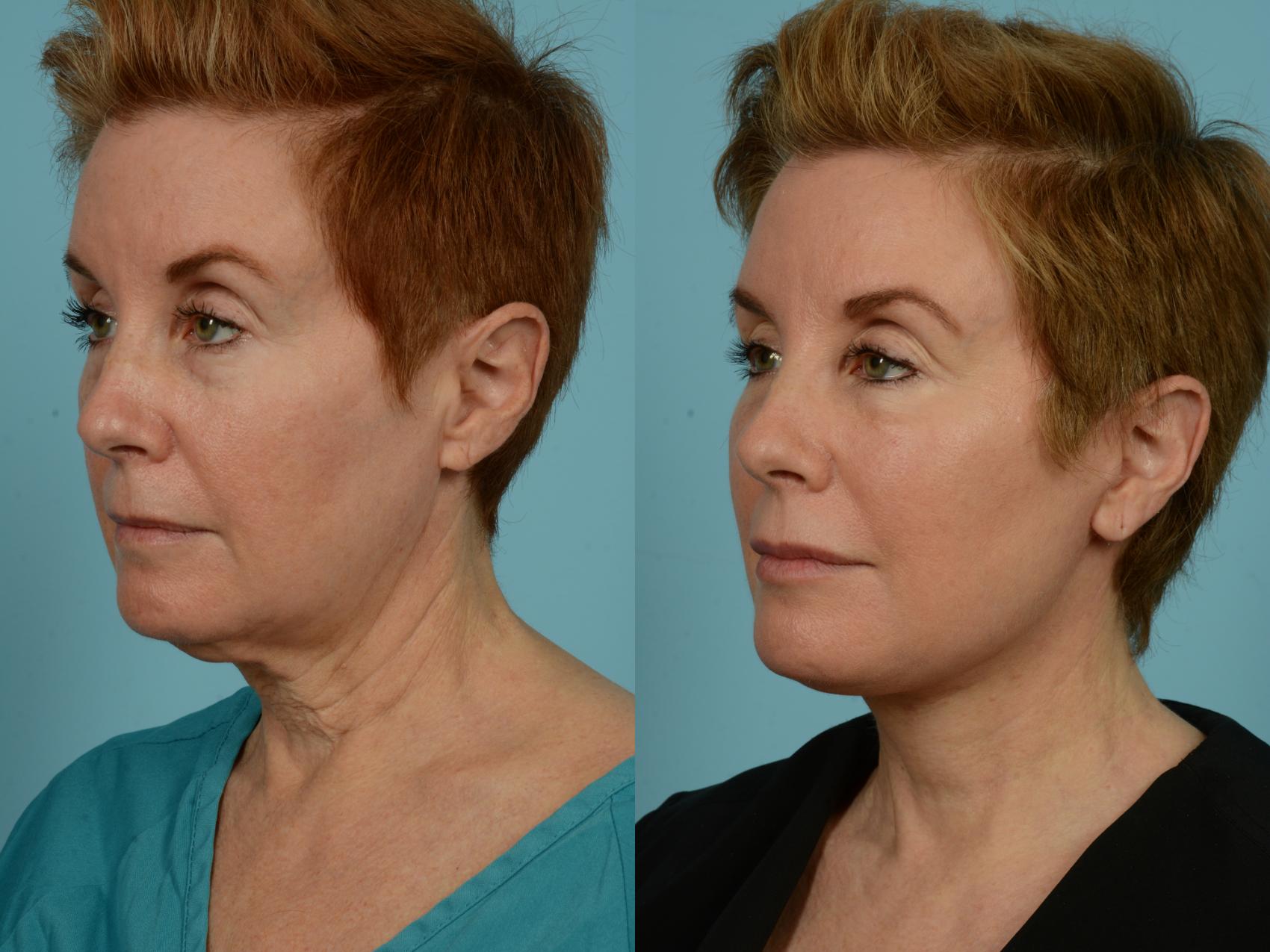 Before & After Neck Lift by Dr. Mustoe Case 932 Left Oblique View in Chicago, IL