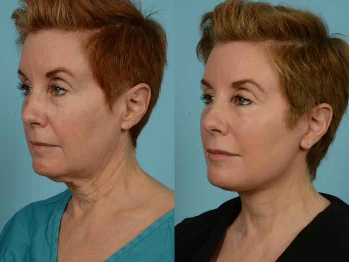 Before & After Facelift/Minilift by Dr. Mustoe Case 932 Left Oblique View in Chicago, IL