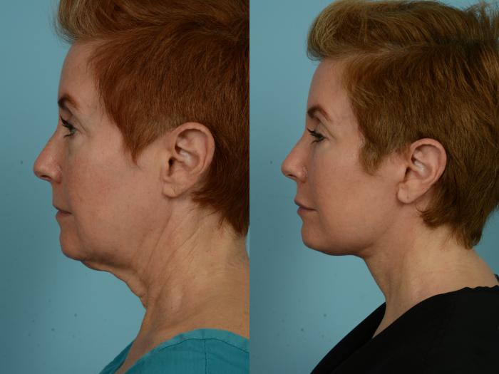 Before & After Neck Lift by Dr. Mustoe Case 932 Left Side View in Chicago, IL