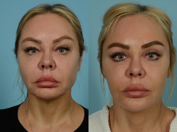 Before & After Facelift/Minilift by Dr. Mustoe Case 933 Front View in Chicago, IL