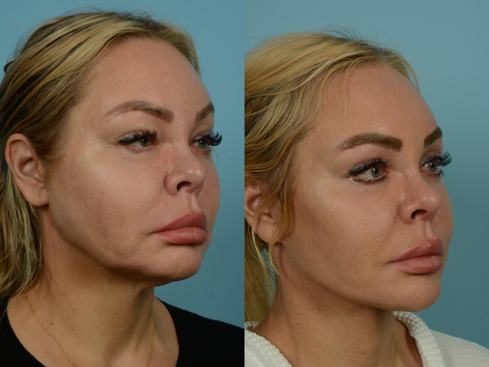 Before & After Facelift/Minilift by Dr. Mustoe Case 933 Right Oblique View in Chicago, IL