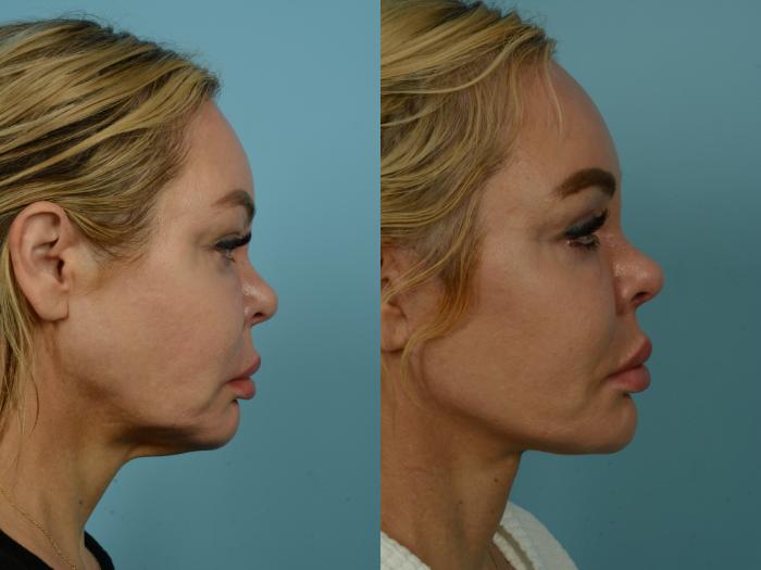 Before & After Blepharoplasty by Dr. Mustoe Case 933 Right Side View in Chicago, IL