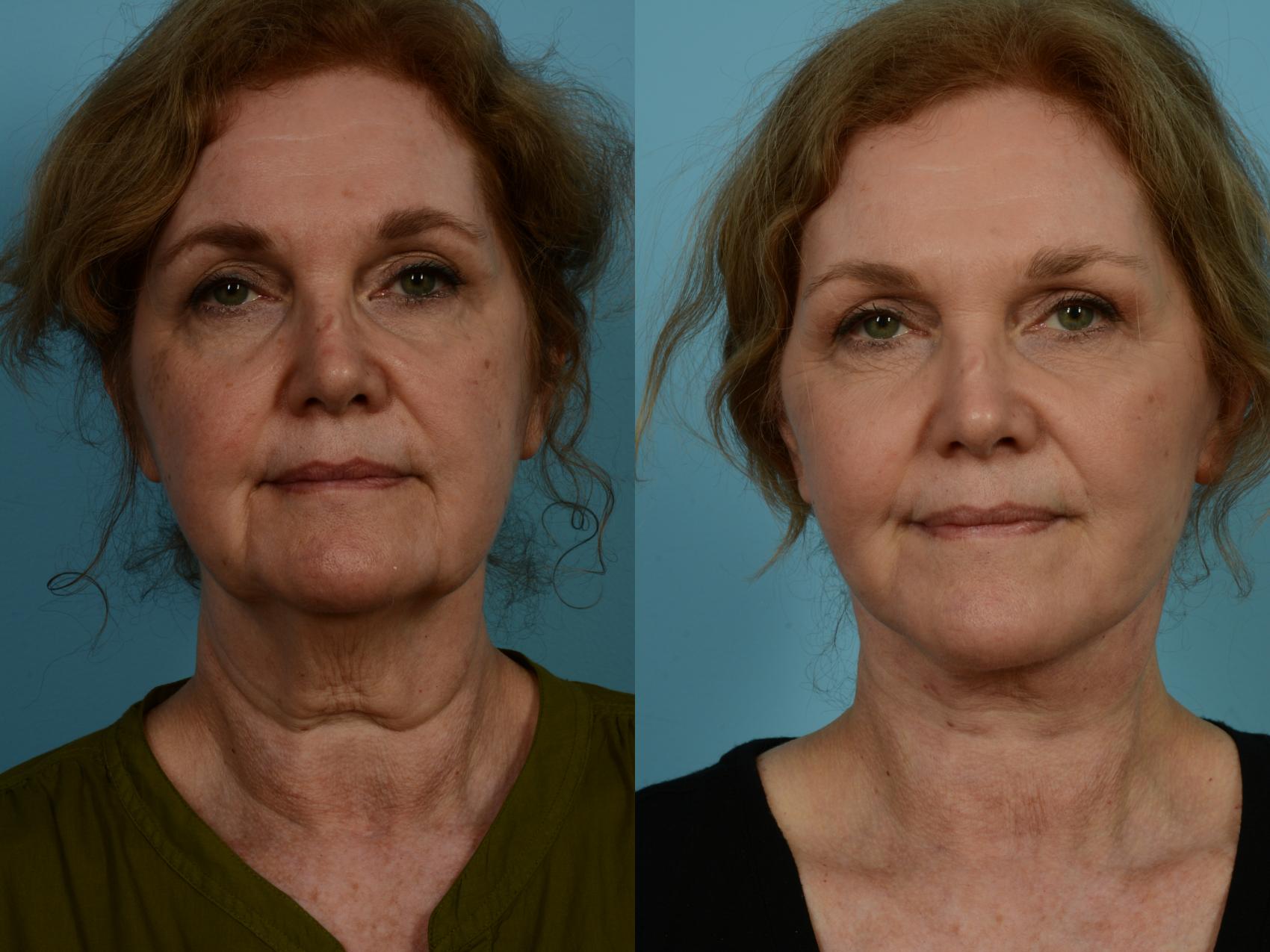 Before & After Facelift/Minilift by Dr. Mustoe Case 934 Front View in Chicago, IL