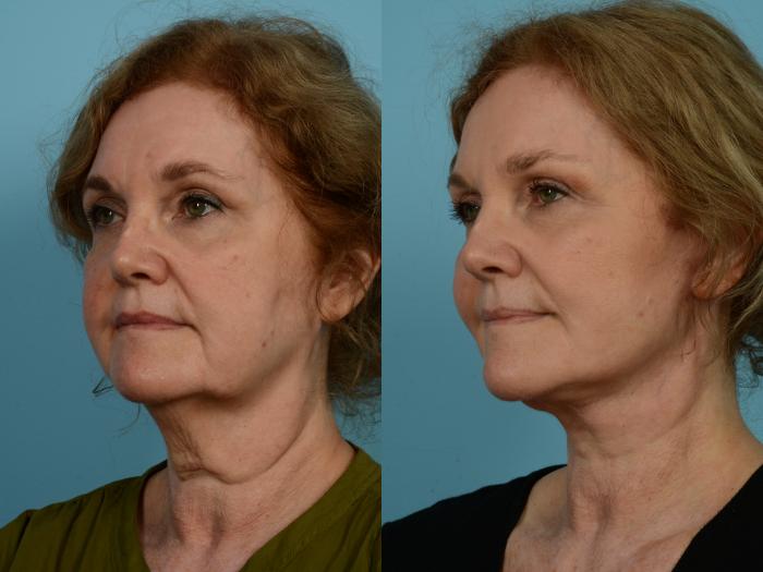 Before & After Neck Lift by Dr. Mustoe Case 934 Left Oblique View in Chicago, IL