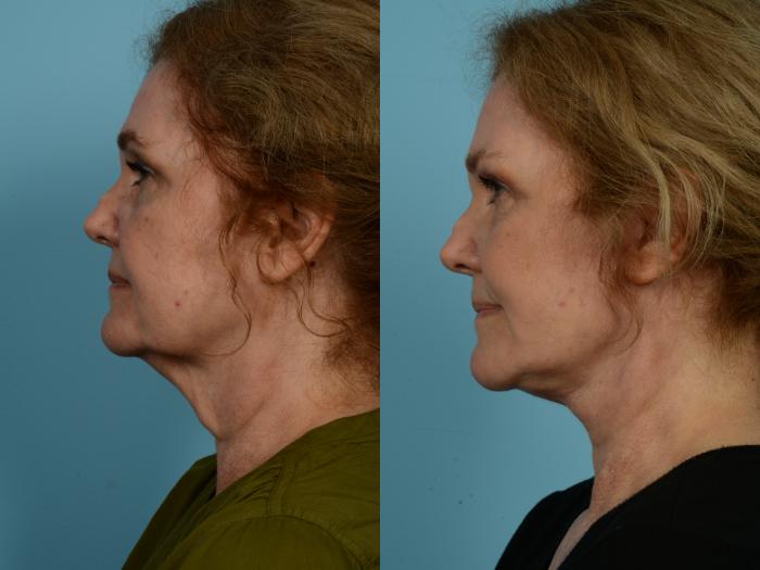 Before & After Neck Lift by Dr. Mustoe Case 934 Left Side View in Chicago, IL