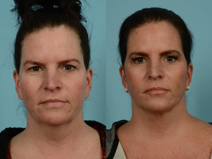 Before & After Facelift/Minilift by Dr. Mustoe Case 937 Front View in Chicago, IL