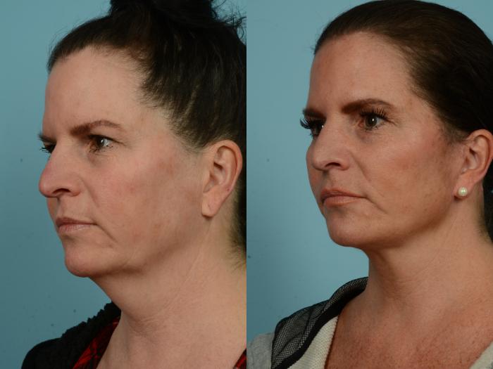 Before & After Facelift/Minilift by Dr. Mustoe Case 937 Left Oblique View in Chicago, IL