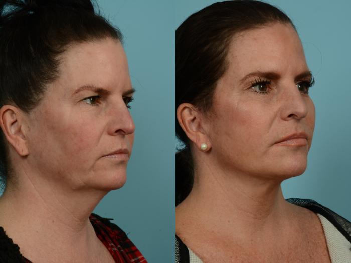 Before & After Neck Lift by Dr. Mustoe Case 937 Right Oblique View in Chicago, IL