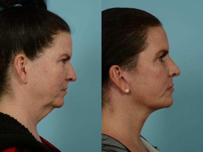 Before & After Neck Lift by Dr. Mustoe Case 937 Right Side View in Chicago, IL