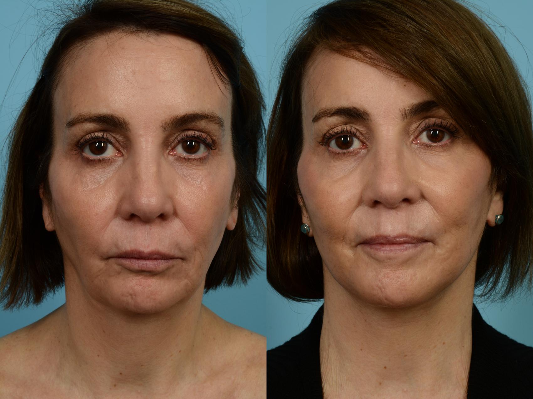 Before & After Fat Grafting by Dr. Mustoe Case 940 Front View in Chicago, IL