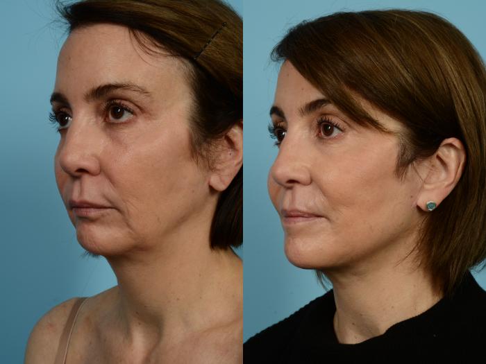 Before & After Facelift/Minilift by Dr. Mustoe Case 940 Left Oblique View in Chicago, IL