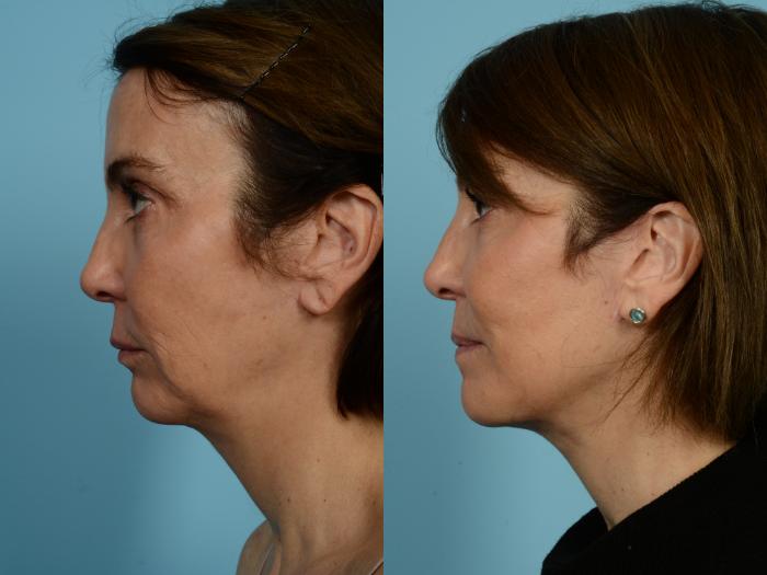 Before & After Fat Grafting by Dr. Mustoe Case 940 Left Side View in Chicago, IL