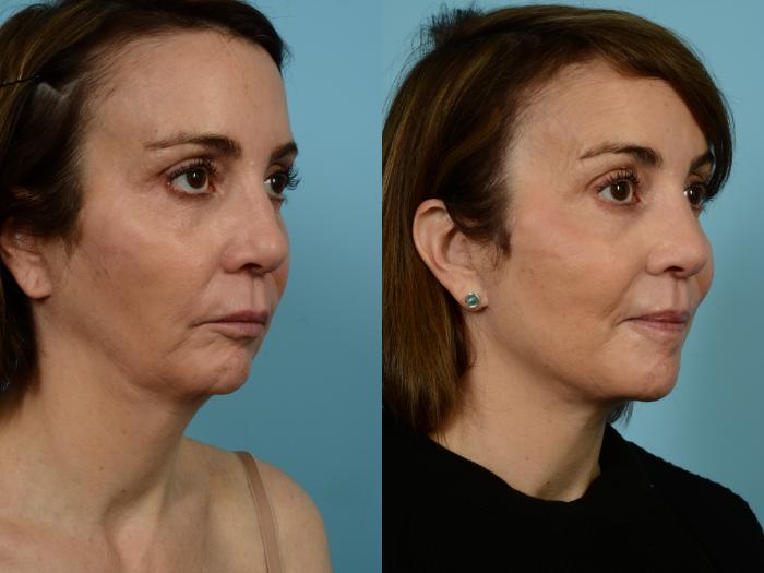 Before & After Facelift/Minilift by Dr. Mustoe Case 940 Right Oblique View in Chicago, IL