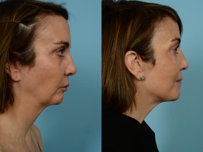 Before & After Facelift/Minilift by Dr. Mustoe Case 940 Right Side View in Chicago, IL