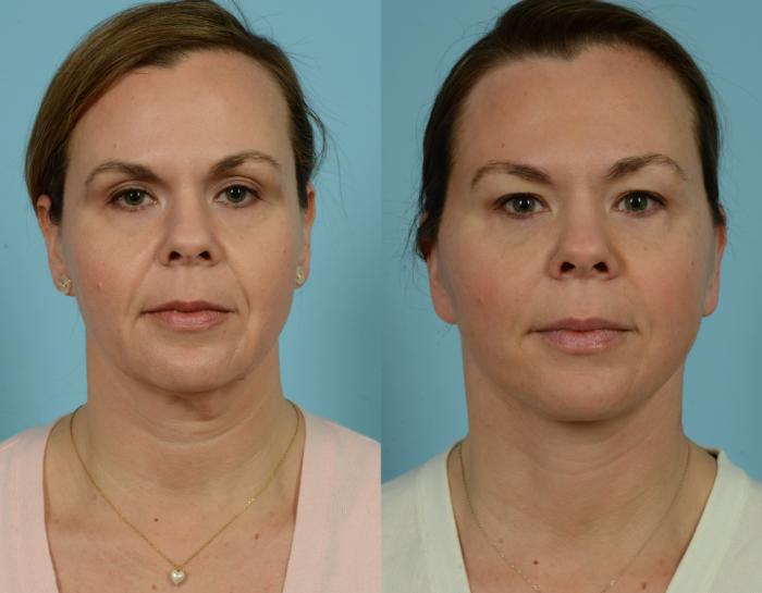 Before & After Midface Lift by Dr. Mustoe Case 941 Front View in Chicago, IL