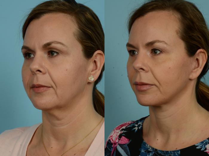 Before & After Facelift/Minilift by Dr. Mustoe Case 941 Left Oblique View in Chicago, IL