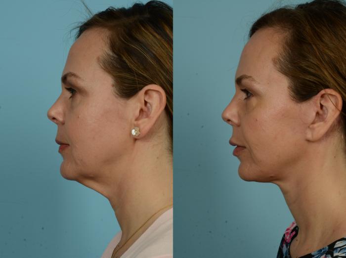 Before & After Midface Lift by Dr. Mustoe Case 941 Left Side View in Chicago, IL