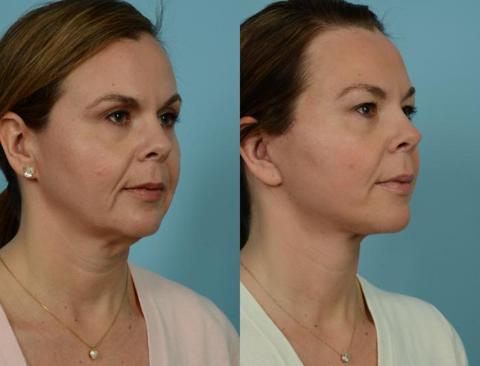 Before & After Neck Lift by Dr. Mustoe Case 941 Right Oblique View in Chicago, IL