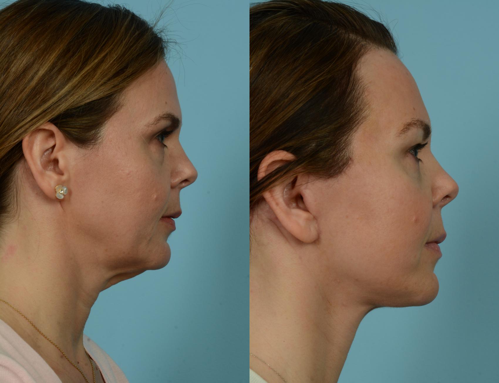 Before & After Midface Lift by Dr. Mustoe Case 941 Right Side View in Chicago, IL