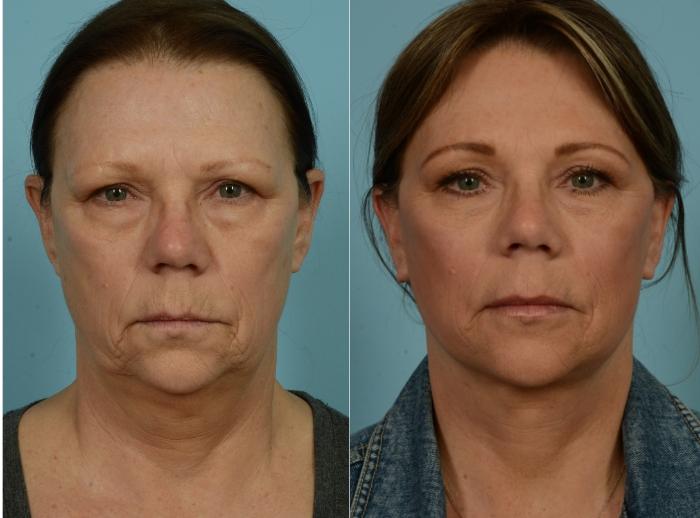 Before & After Facelift/Minilift by Dr. Mustoe Case 973 Front View in Chicago, IL
