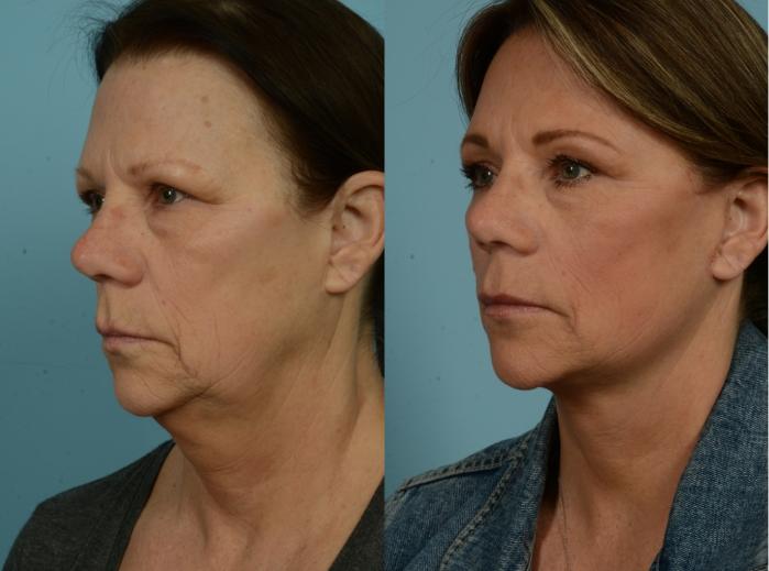 Before & After Facelift/Minilift by Dr. Mustoe Case 973 Left Oblique View in Chicago, IL