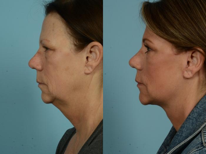 Before & After Facelift/Minilift by Dr. Mustoe Case 973 Left Side View in Chicago, IL