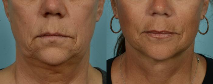 Before & After Fat Grafting by Dr. Mustoe Case 973 Mouth View in Chicago, IL