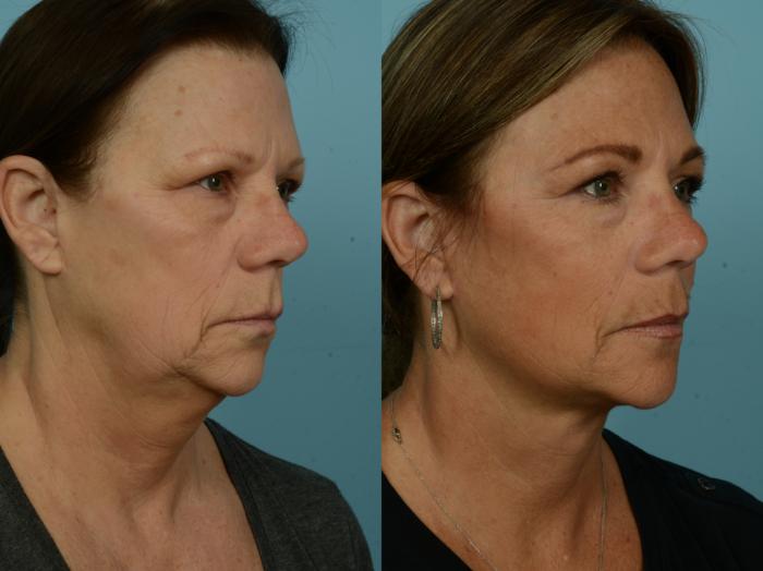 Before & After Neck Lift by Dr. Mustoe Case 973 Right Oblique View in Chicago, IL